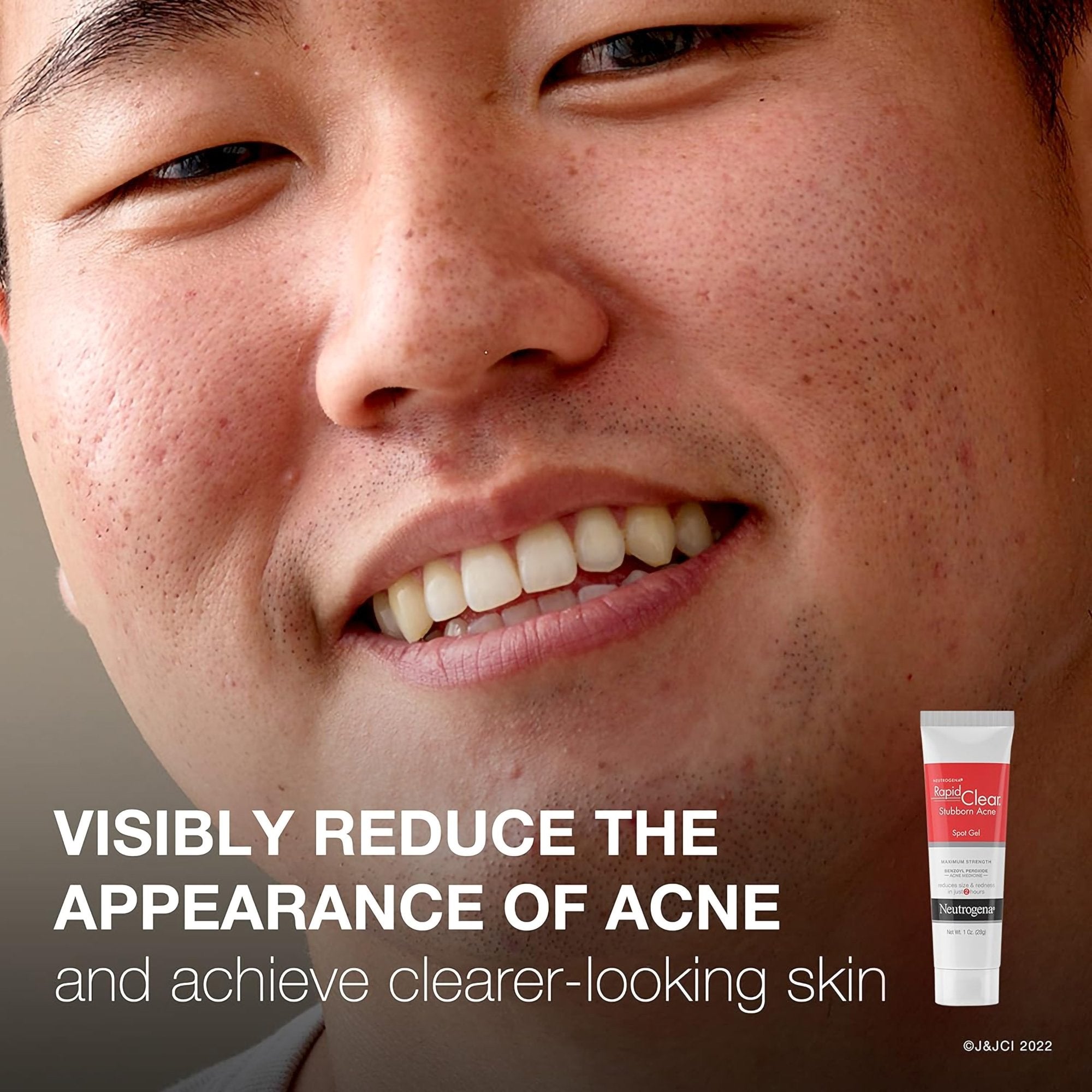 Acne Treatment Neutrogena® Rapid Clear 1 oz. Gel 69968004301