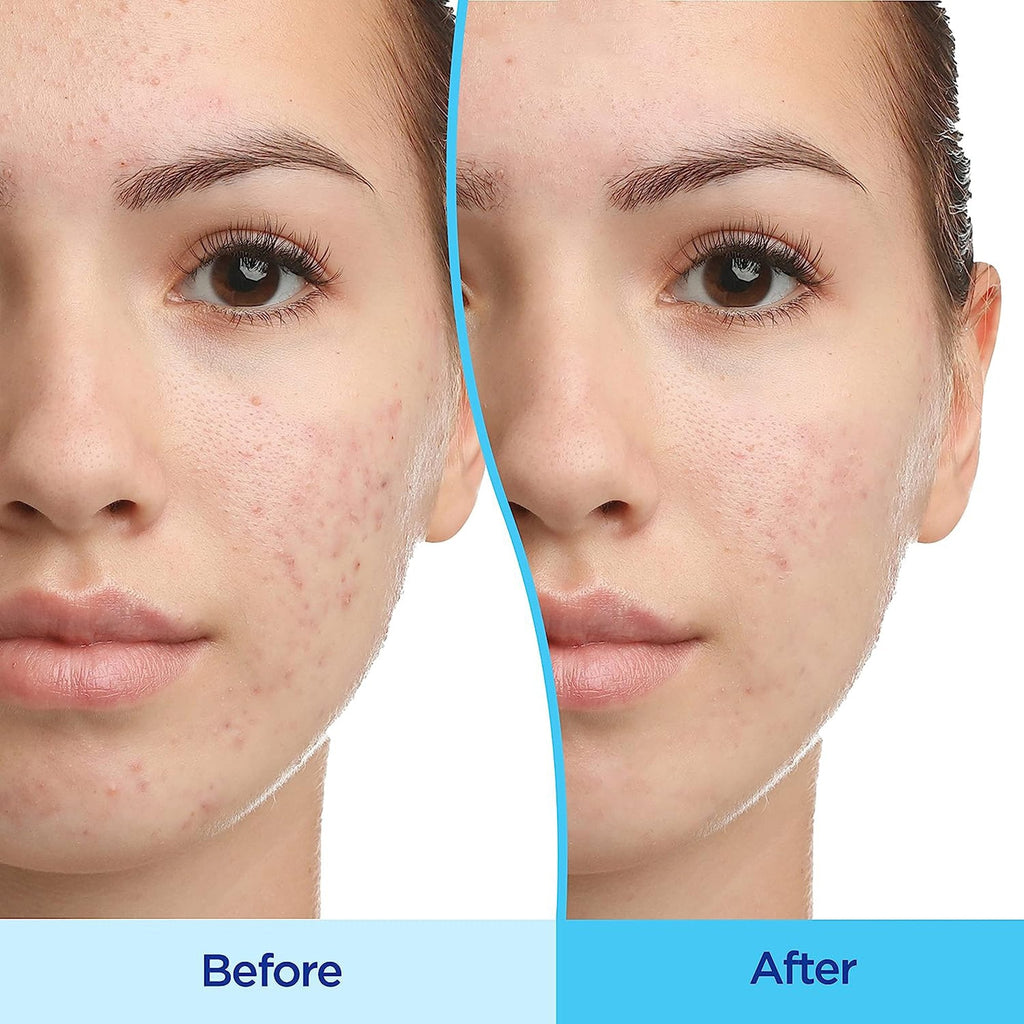 Acne Treatment Differin® 45 Gram Gel 30299492045