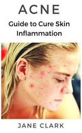 ACNE: Guide to Cure Skin Inflammation