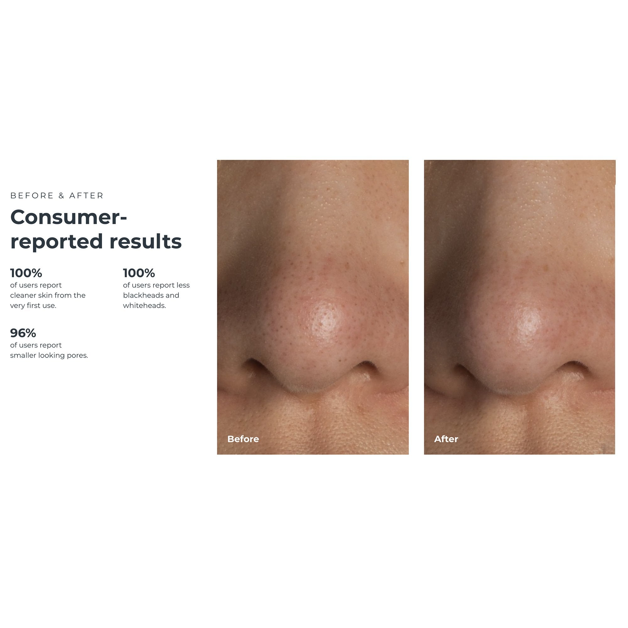 KIWI™ Blackhead Remover Pore Vaccum F1948