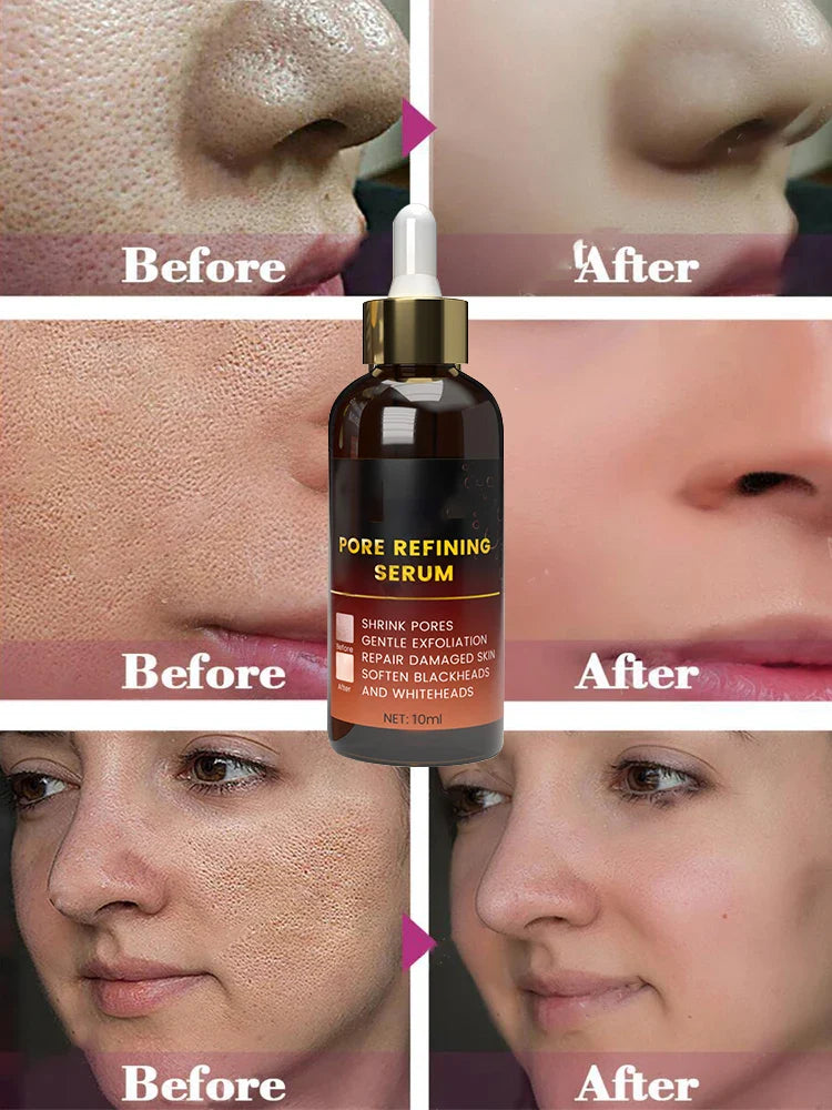 Acne Treatment Anti Aging Serum.