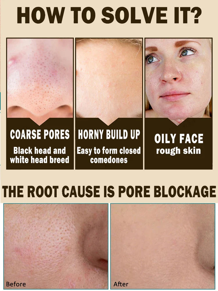 Acne Treatment Anti Aging Serum.