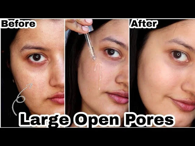Acne Treatment Anti Aging Serum.