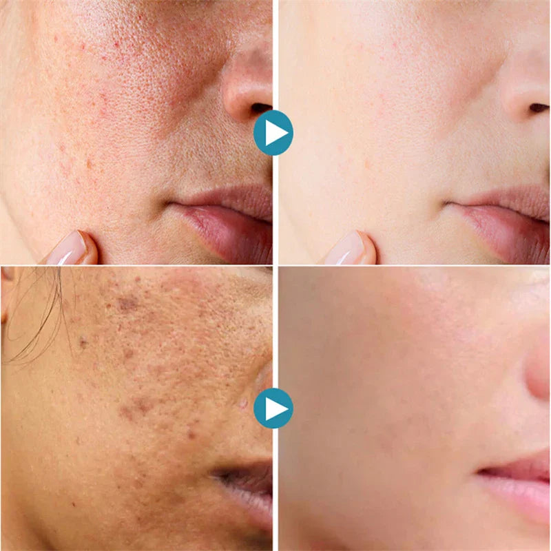Acne Treatment Anti Aging Serum.