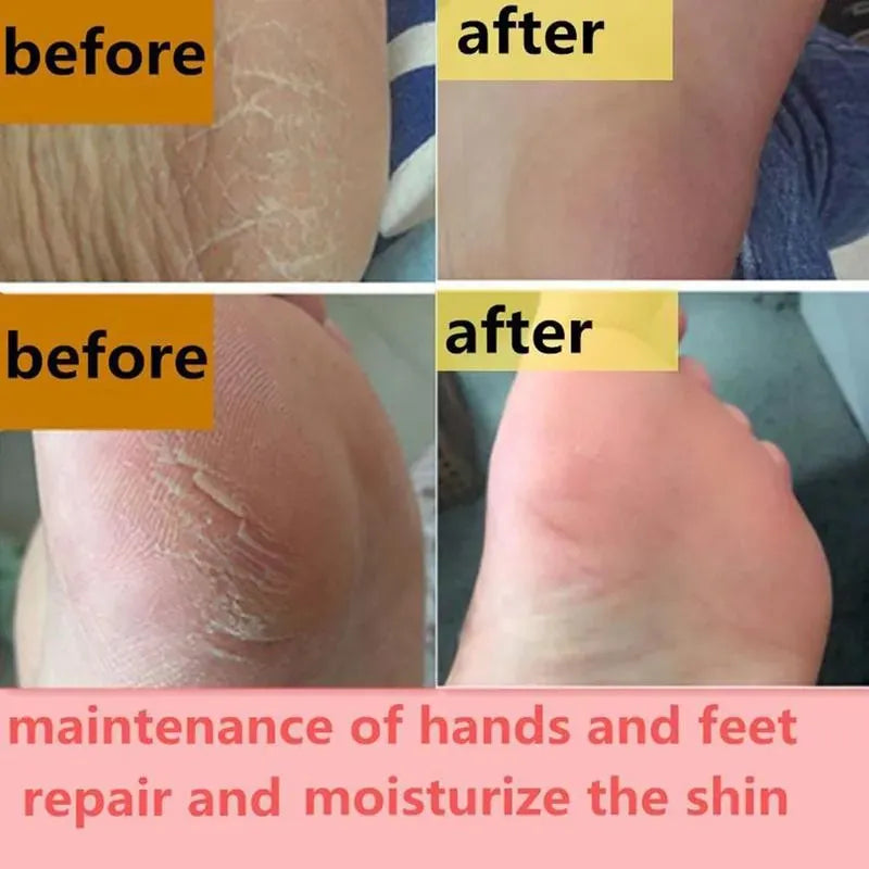 Feet and Hand Crack Removal Cream.