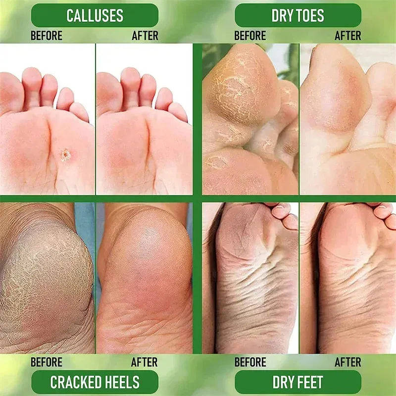 Herbal Anti Crack Foot Heel Cracking Repair Cream.