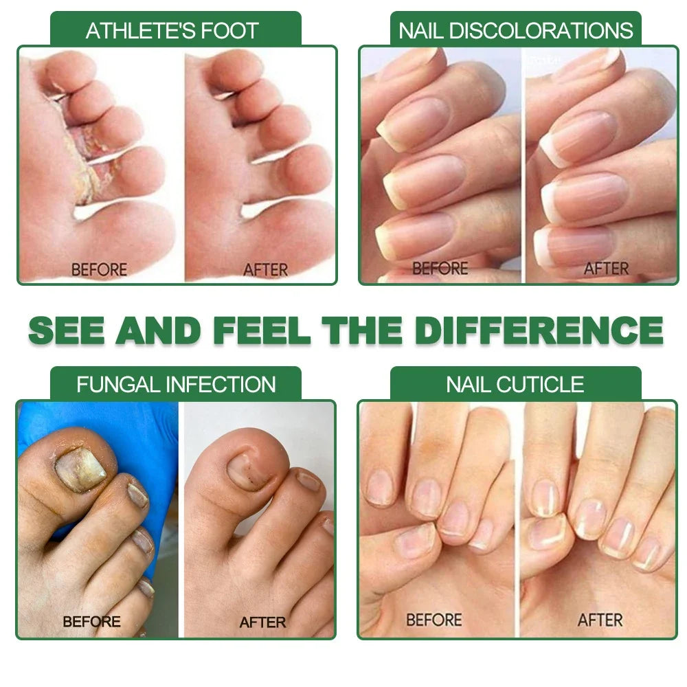 7 Days Fungal Nail Treatment Serum Foot Nail Fungus Removal Repair Gel Anti Infection Paronychia Onychomycosis Foot Nails Care