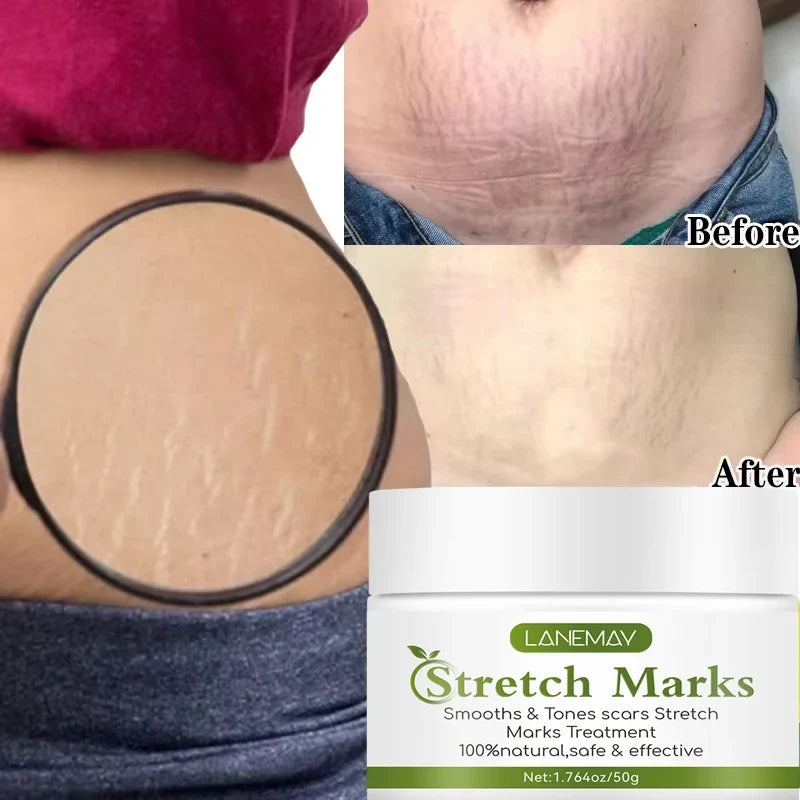 Stretch Marks Permanent Removal Cream Maternity Pregnant Women Pregnancy Anti-Winkle Smooth Repair Firming Skin Body Skin Care