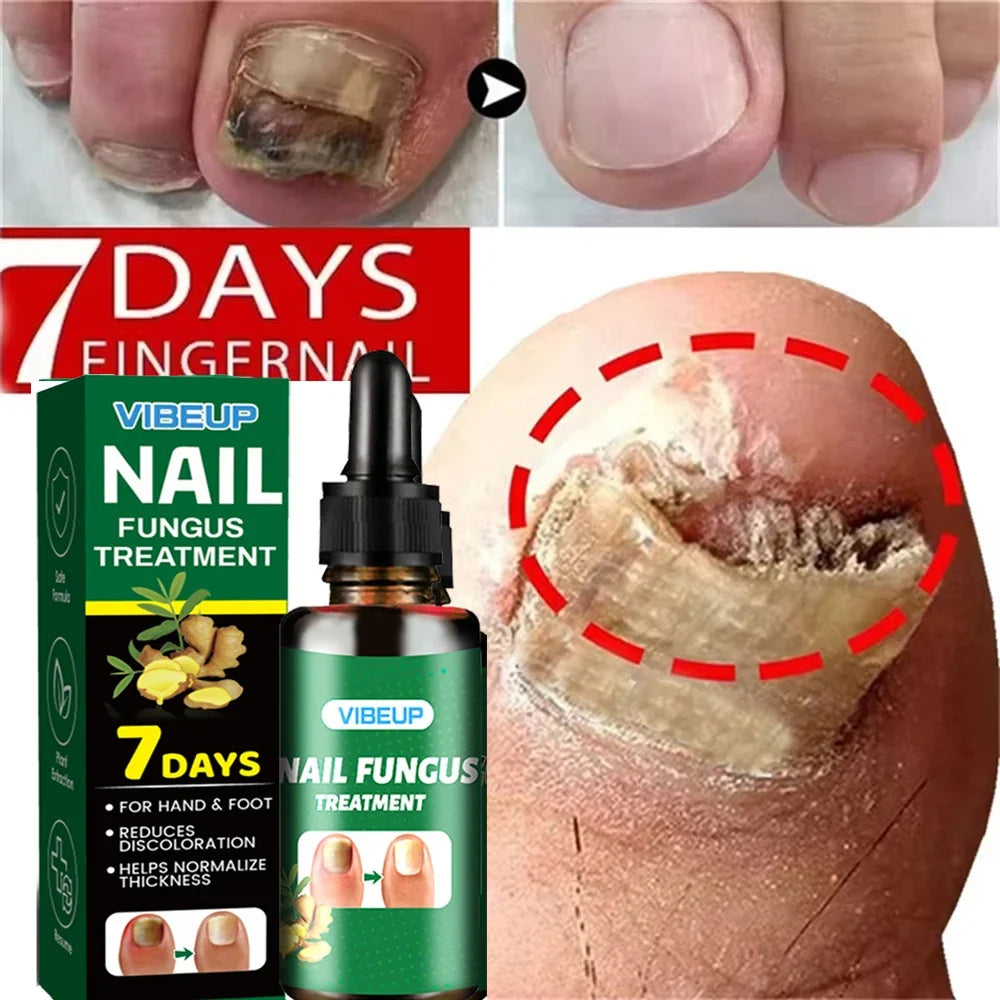7 Days Fungal Nail Treatment Serum Foot Nail Fungus Removal Repair Gel Anti Infection Paronychia Onychomycosis Foot Nails Care