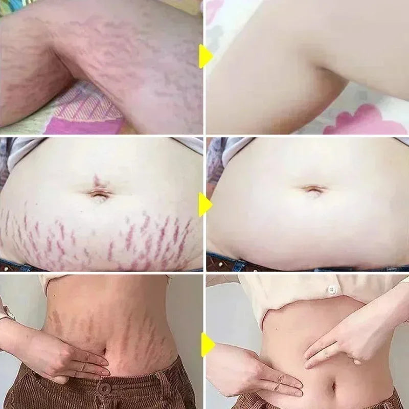 Cream For Pregnancy Stretch Marks Removal Eliminate Red White Old Stretch Marks 26