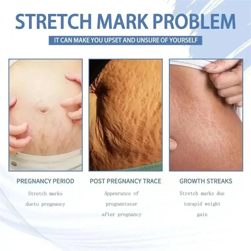 Cream For Pregnancy Stretch Marks Removal Eliminate Red White Old Stretch Marks 26