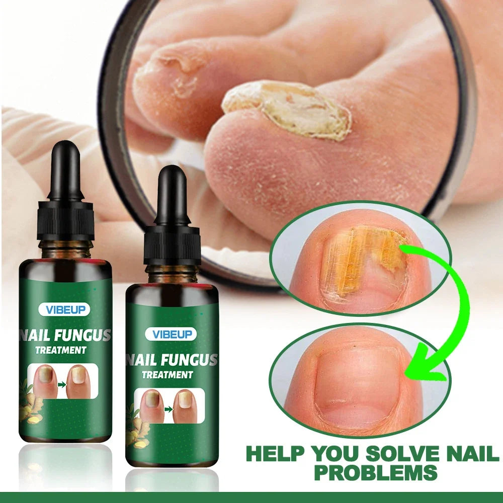 7 Days Fungal Nail Treatment Serum Foot Nail Fungus Removal Repair Gel Anti Infection Paronychia Onychomycosis Foot Nails Care