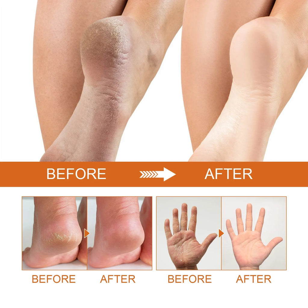 Jaysuing Foot exfoliating spray cleanses and removes dead skin to prevent dryness, nourish and moisturize foot skin care spray