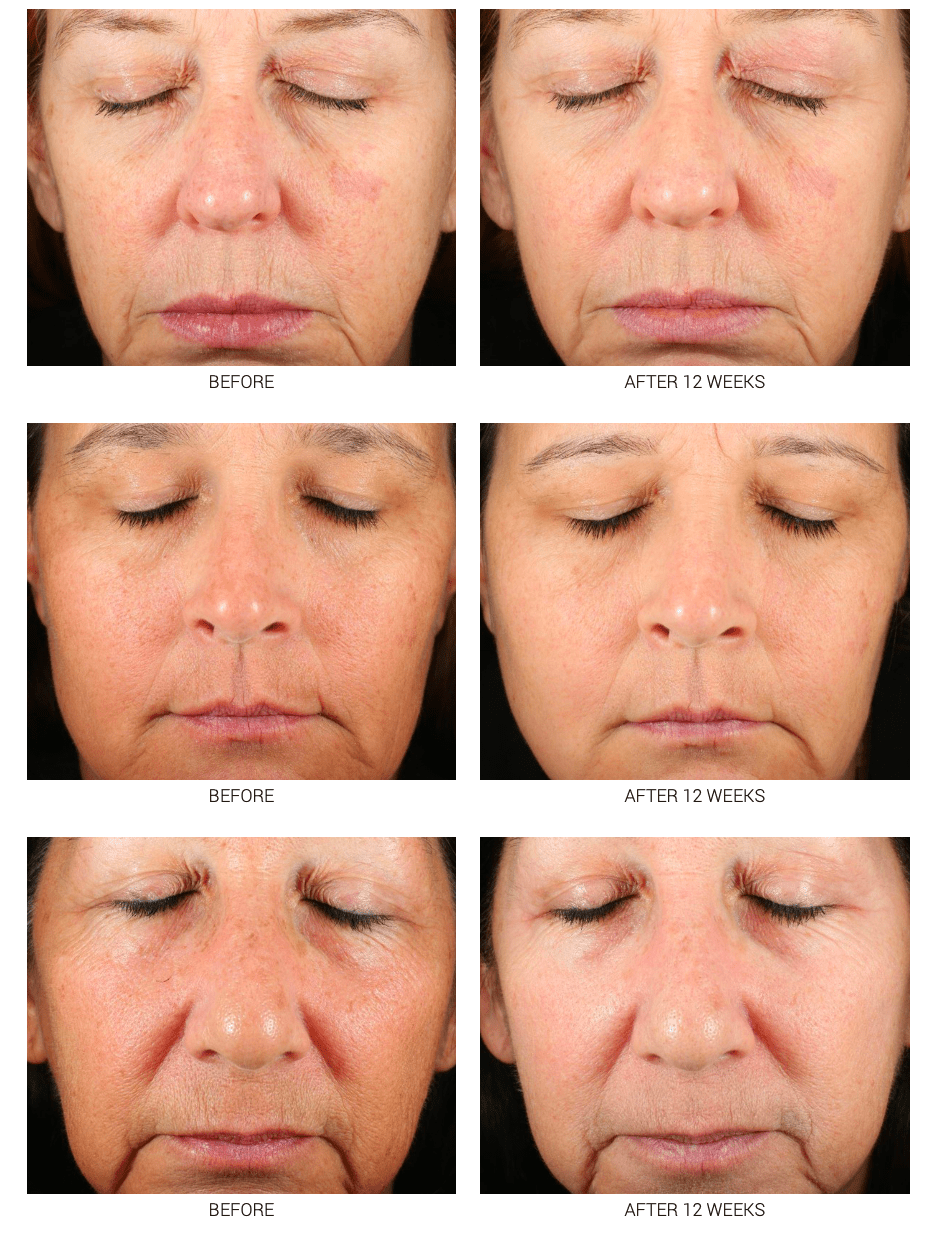 Advanced WRI - LAX 5x - PhishStones Products