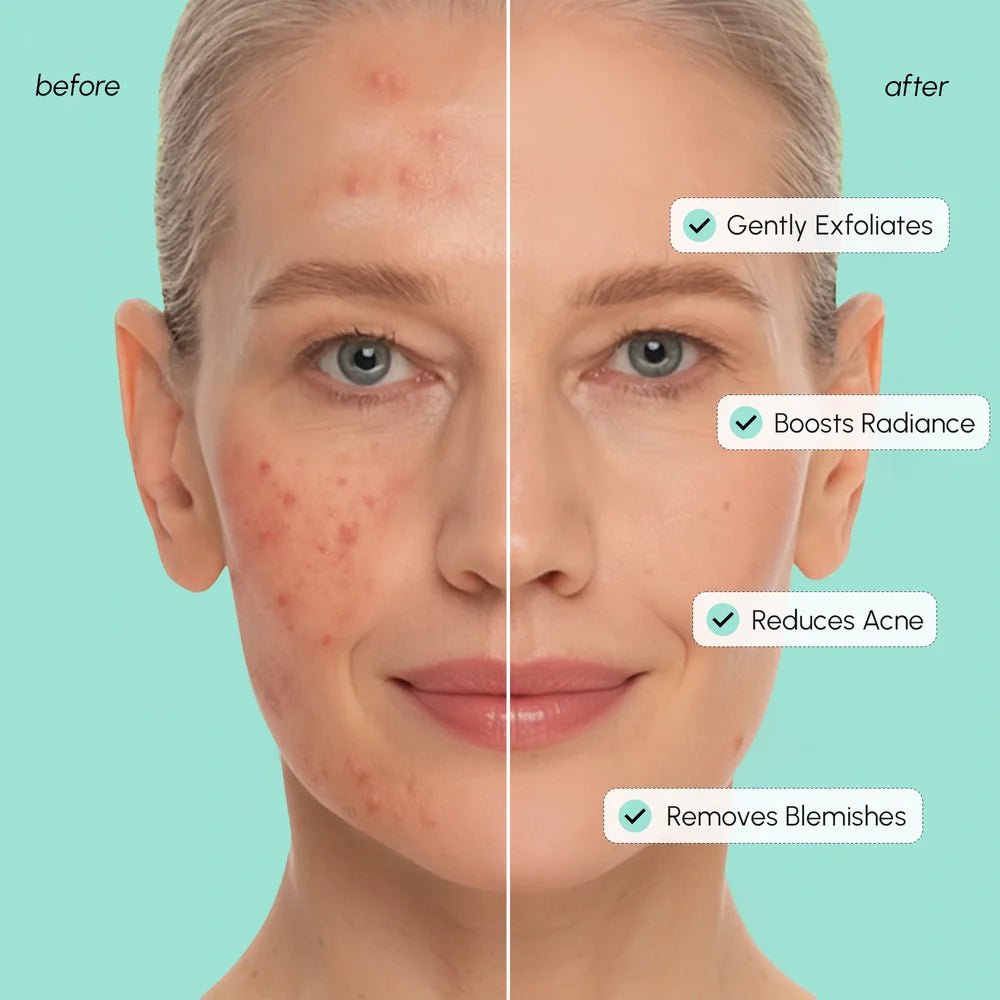 Azelaic Acid Soothing Pads - PhishStones Products