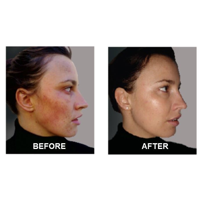 Derm 1 Adult Acne Two - Step Regimen plus FREE Blemish Corrector - PhishStones Products