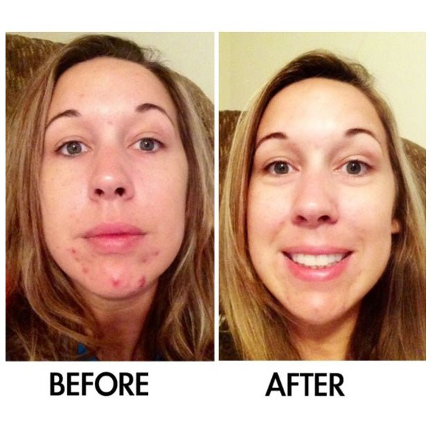 Derm 1 Adult Acne Two - Step Regimen plus FREE Blemish Corrector - PhishStones Products