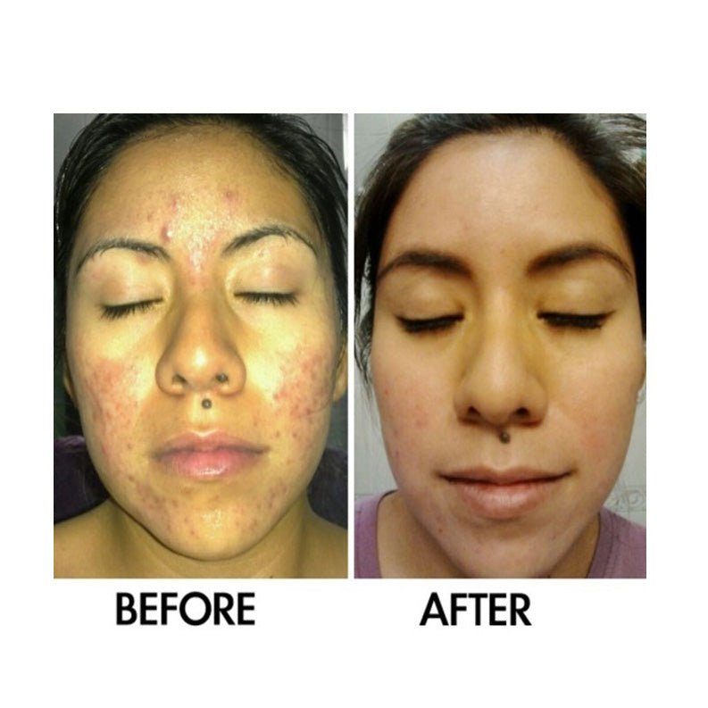 Derm 1 Adult Acne Two - Step Regimen plus FREE Blemish Corrector - PhishStones Products