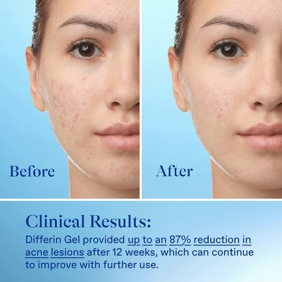 Differin Retinoid Acne Treatment; Adapalene Gel 0.1% 45g/1.6oz - Imperfect Box - PhishStones Products